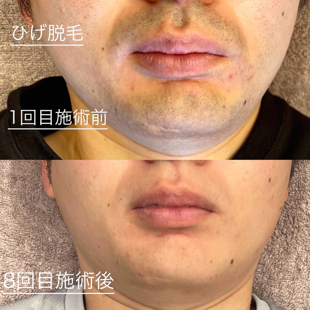 ひげ脱毛ビフォーアフター症例3 静岡県清水町MEN'S美容次郎