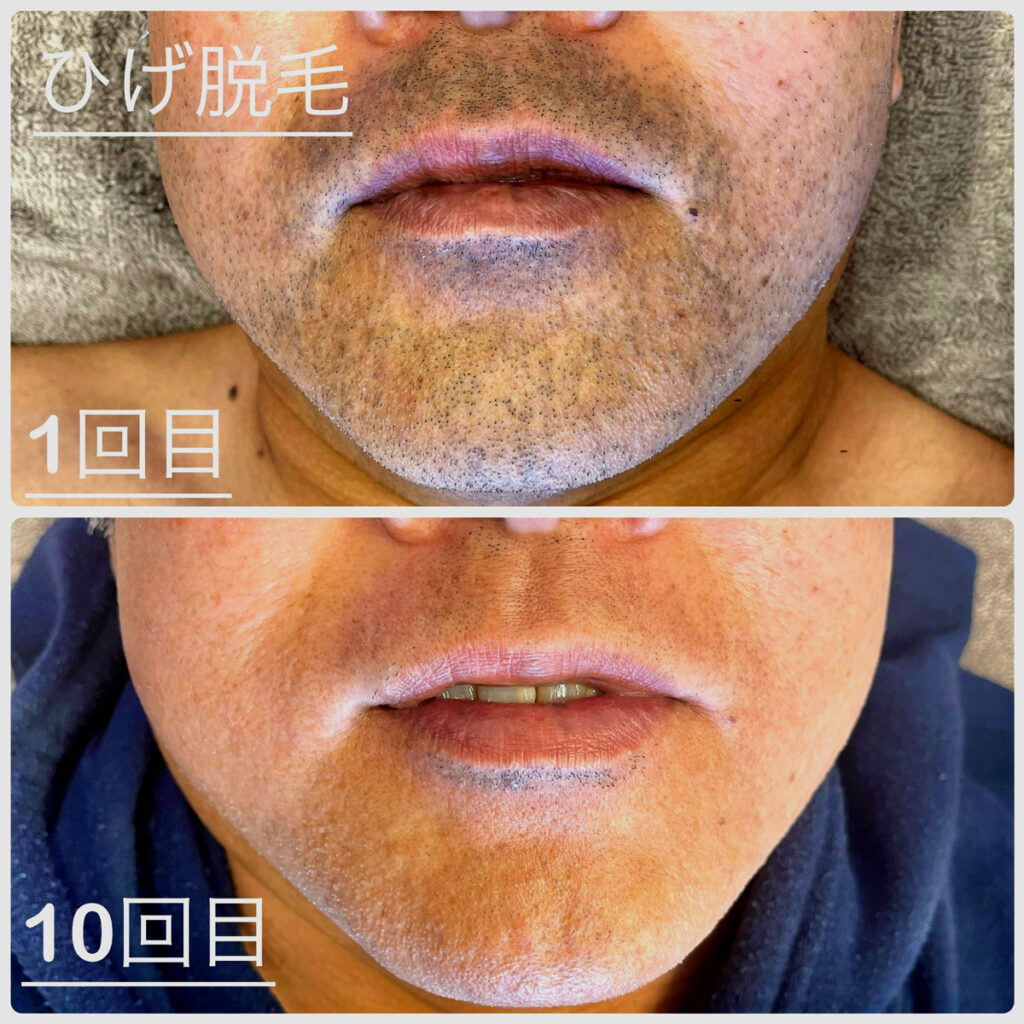 ひげ脱毛ビフォーアフター症例1 静岡県清水町MEN'S美容次郎