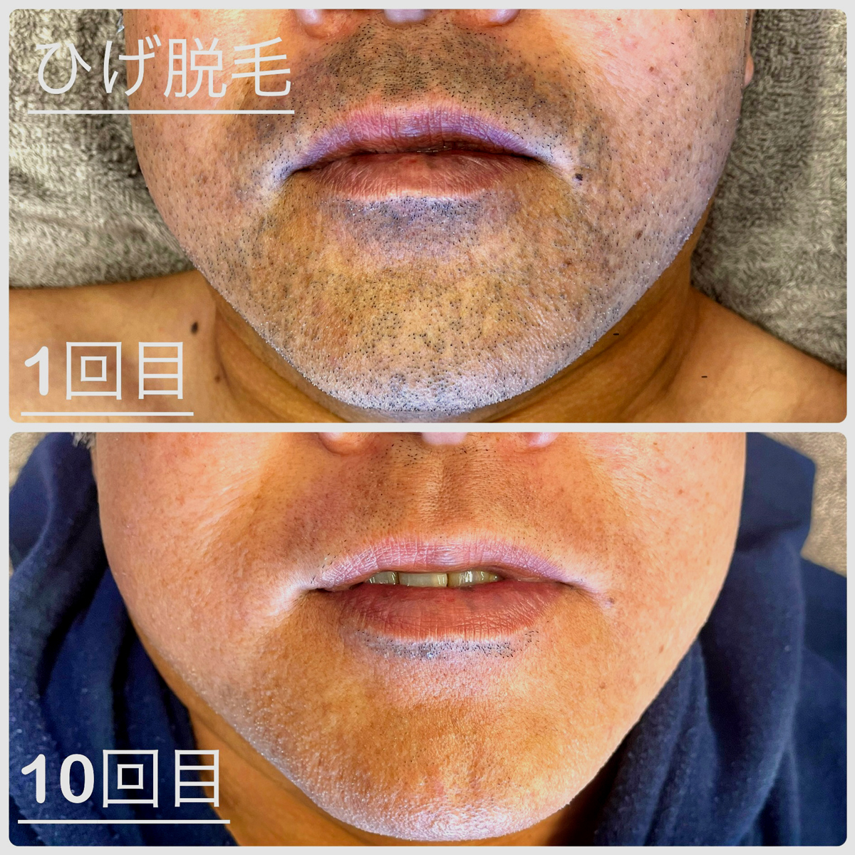 ヒゲ脱毛症例個別01のページにリンクしています