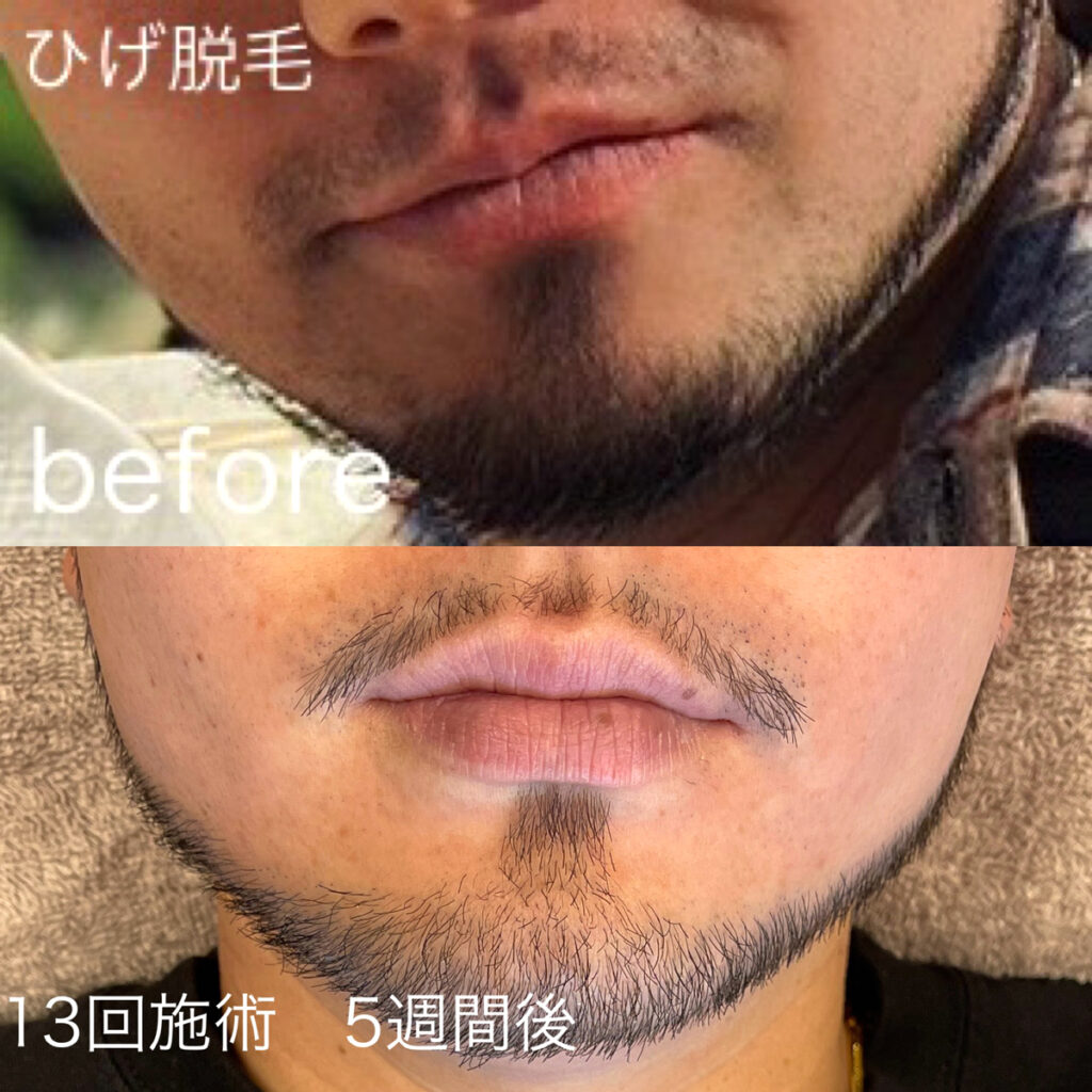 ひげ脱毛デザインビフォーアフター症例1 静岡県清水町MEN'S美容次郎