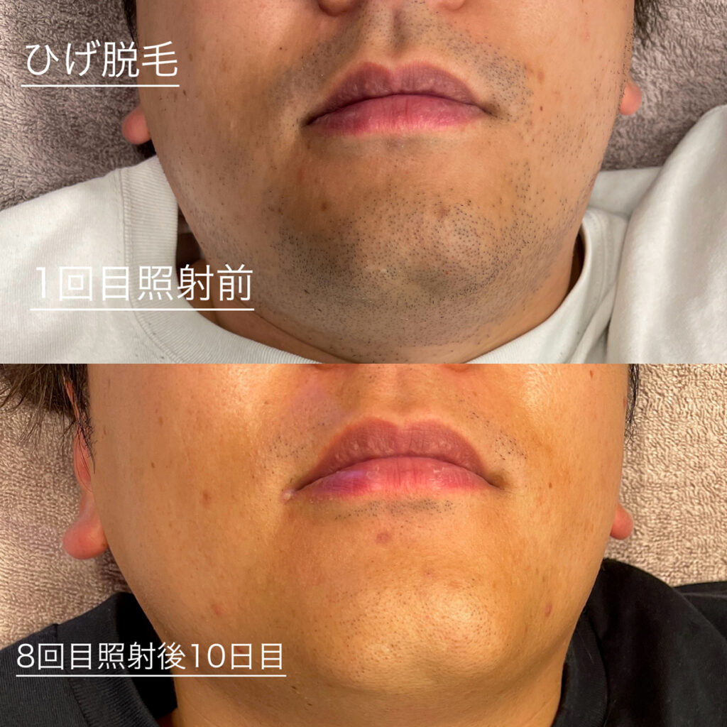 ひげ脱毛ビフォーアフター症例2 静岡県清水町MEN'S美容次郎