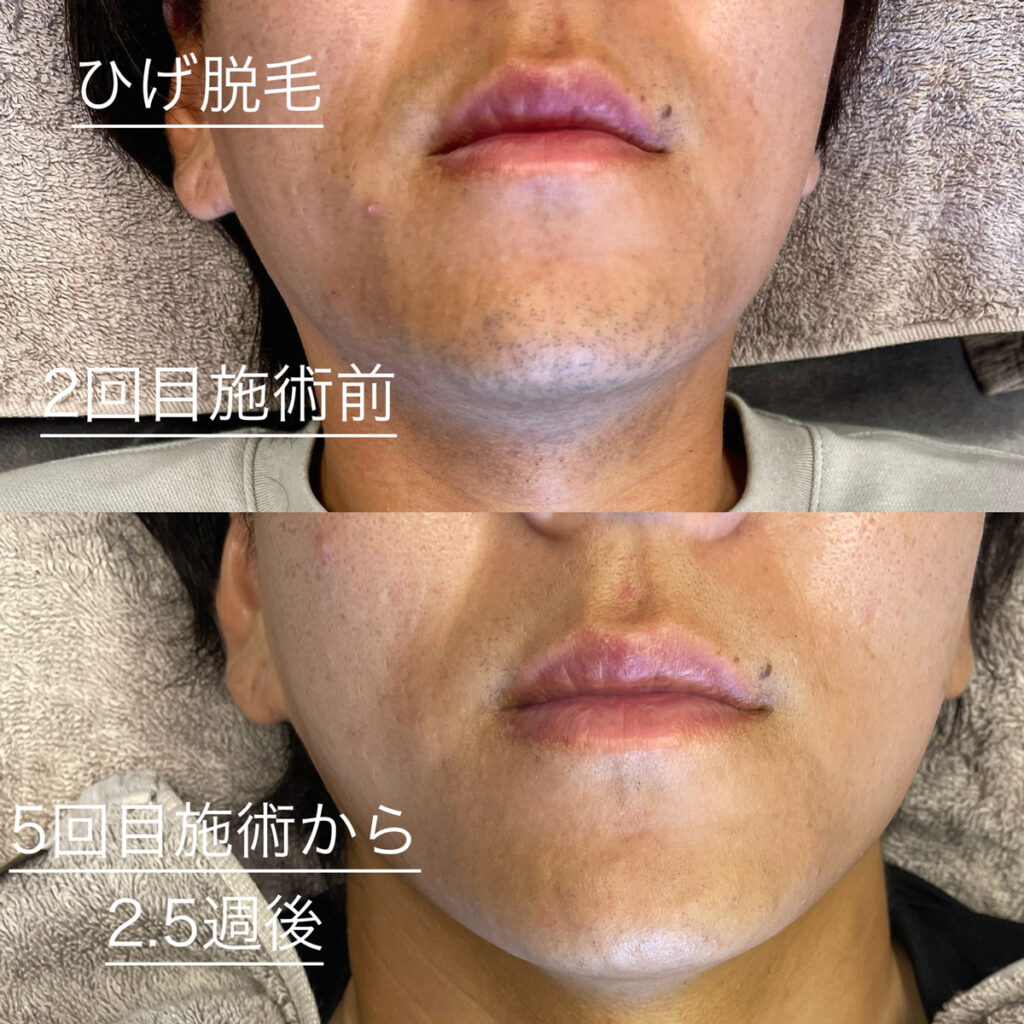 ひげ脱毛ビフォーアフター症例4 静岡県清水町MEN'S美容次郎