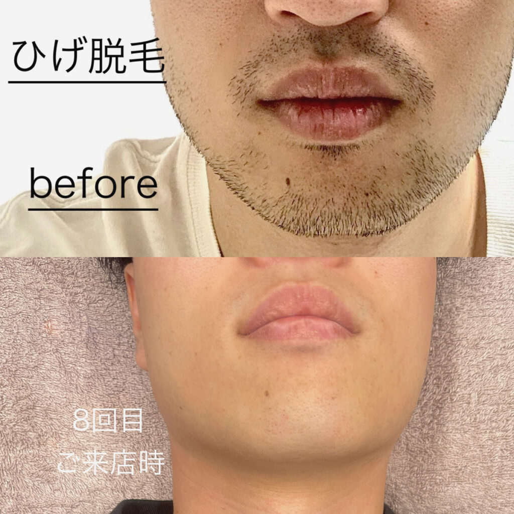 ひげ脱毛ビフォーアフター症例5 静岡県清水町MEN'S美容次郎