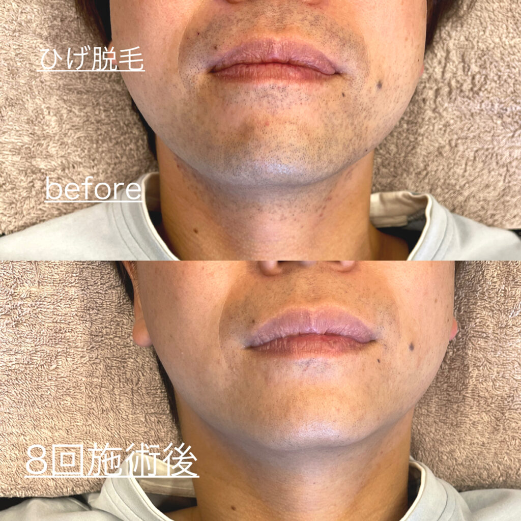 ひげ脱毛ビフォーアフター症例6 静岡県清水町MEN'S美容次郎