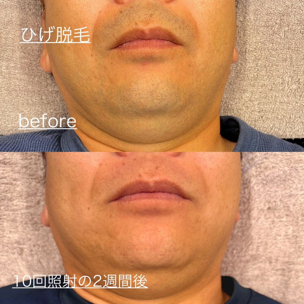 ひげ脱毛ビフォーアフター症例7 静岡県清水町MEN'S美容次郎