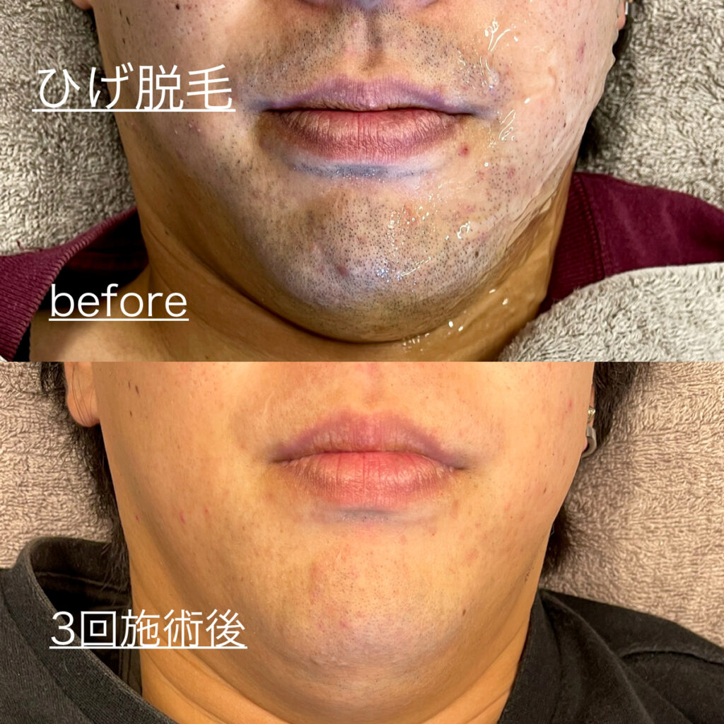 ひげ脱毛ビフォーアフター症例8 静岡県清水町MEN'S美容次郎