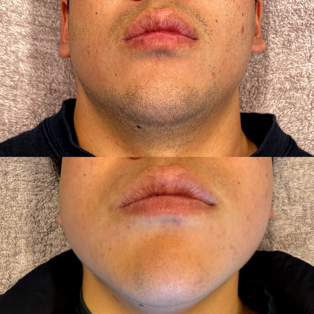 ひげ脱毛ビフォーアフター症例9 静岡県清水町MEN'S美容次郎