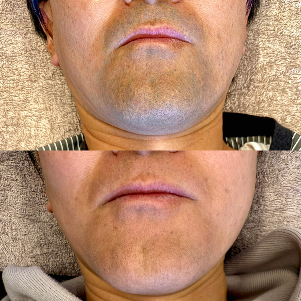 ひげ脱毛ビフォーアフター症例10 静岡県清水町MEN'S美容次郎