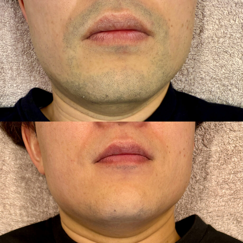 ひげ脱毛ビフォーアフター症例11 静岡県清水町MEN'S美容次郎
