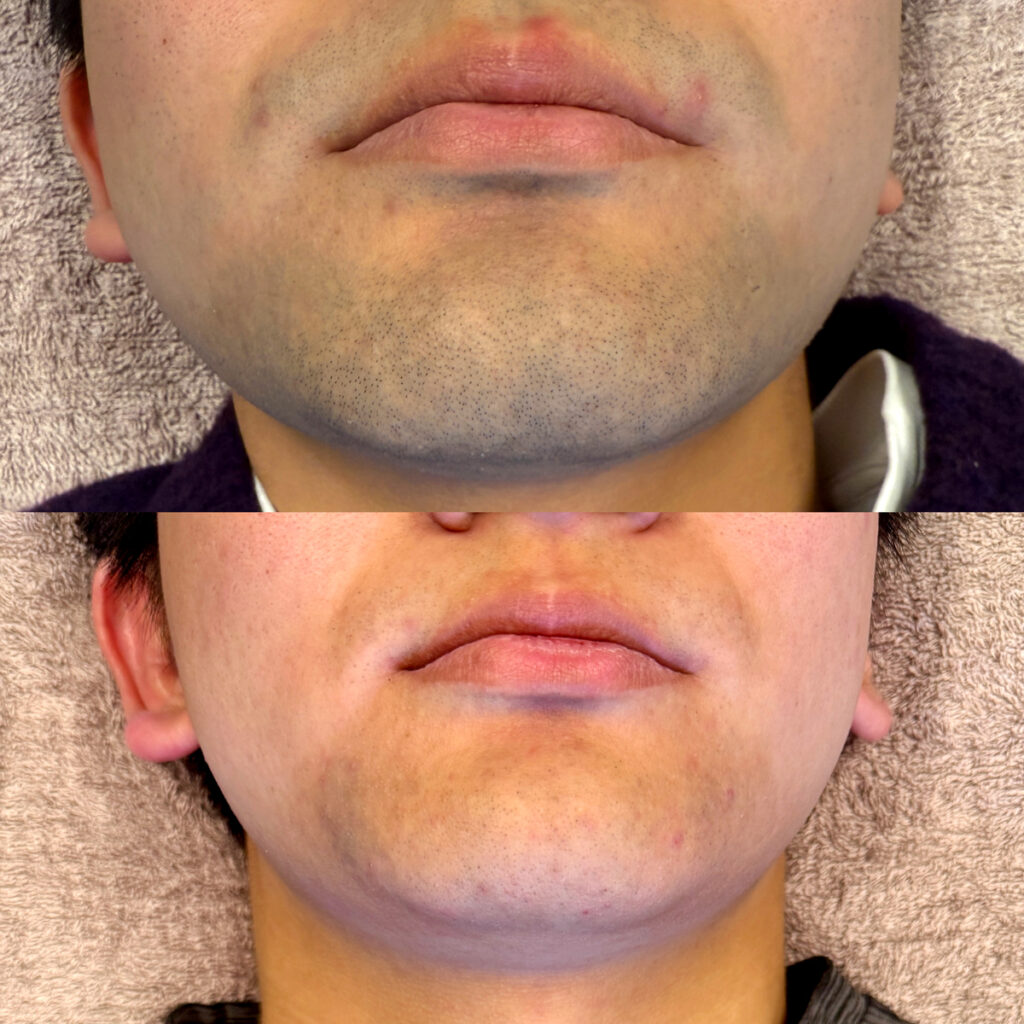 ひげ脱毛ビフォーアフター症例12 静岡県清水町MEN'S美容次郎