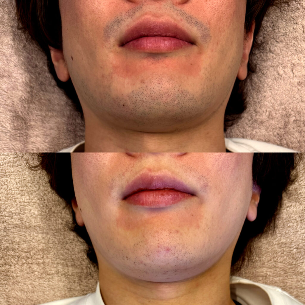 ひげ脱毛ビフォーアフター症例13 静岡県清水町MEN'S美容次郎